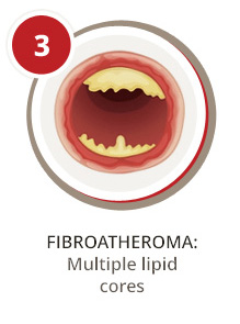 Fibroatheroma