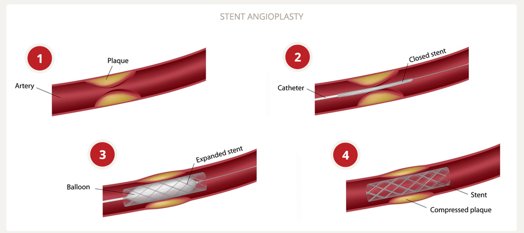 stent angioplasty