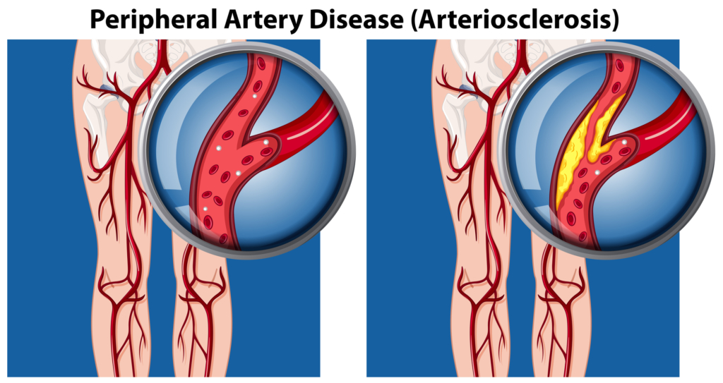 A Comparison of Peripheral Artery Disease illustration