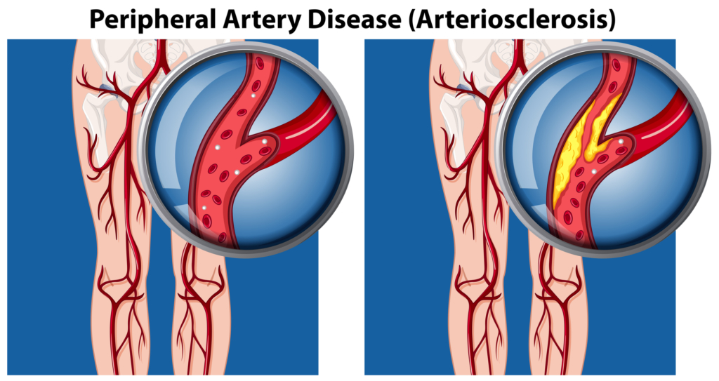 A Comparison of Peripheral Artery Disease A Comparison of Peripheral Artery Disease