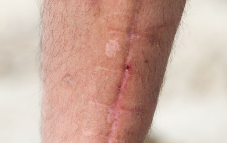Leg scan healing poorly with PAD