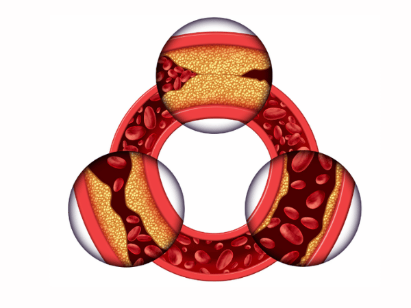 Severe Artery Blockage