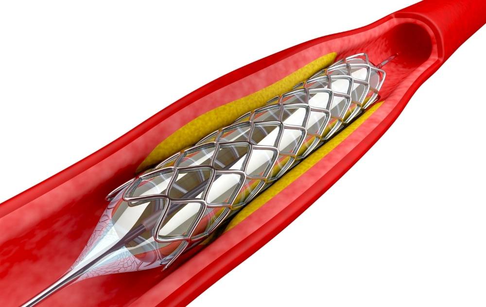 How To Treat Premature Peripheral Artery Disease USA Vascular Centers