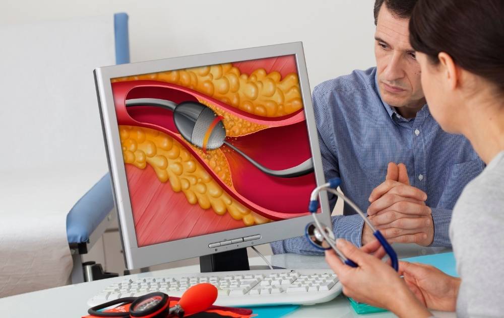 What Is An Atherectomy Procedure? USA Vascular Centers