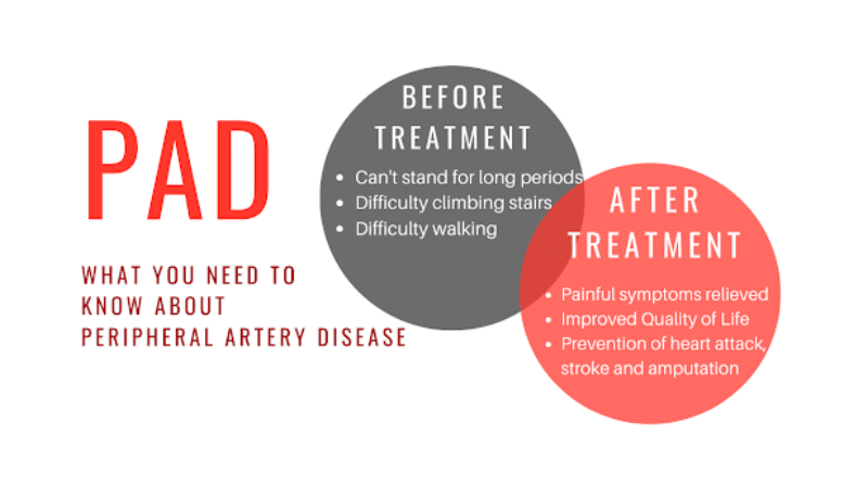What You Need to Know About Smoking and Peripheral Artery Disease (PAD) Graphic