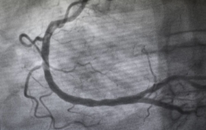 Image of angiogram depicting artery