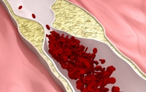 Premature peripheral artery disease diagram medical