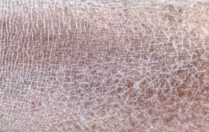 Up close picture of dry skin on leg