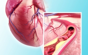 Coronary artery disease diagram