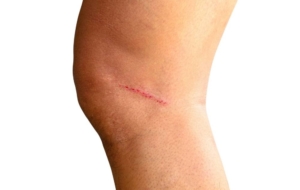 Leg with small cut above the knee