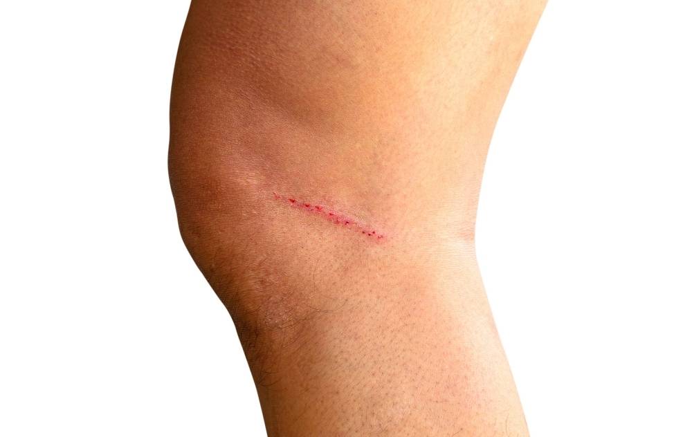 Slow-Healing Wounds On Legs: What To Do | USA Vascular Centers