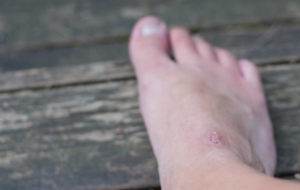 Foot with small open wound