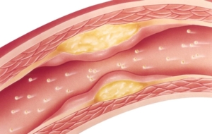 Arterial plaque accumulation within the artery diagram