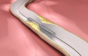 Angioplasty diagram of artery with stent