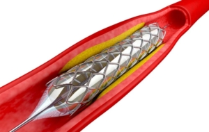 Stent angioplasty for premature peripheral vascular disease