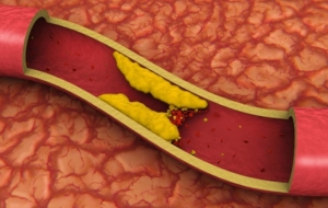 Clogged artery with plaque peripheral artery disease