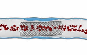 Stent angioplasty diagram showing blood flow through stent