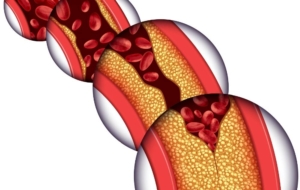 Artery diagram with plaque buildup progression