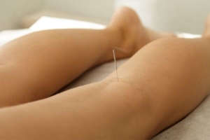 acupuncture needle in lower leg