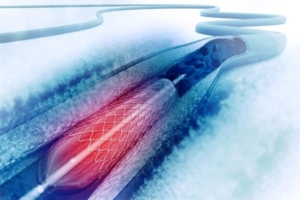 Stent angioplasty using to treat blocked artery diagram