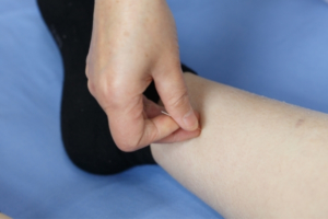 Doctor placing acupuncture needles in leg