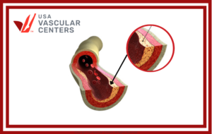 Calcium Deposits and PAD