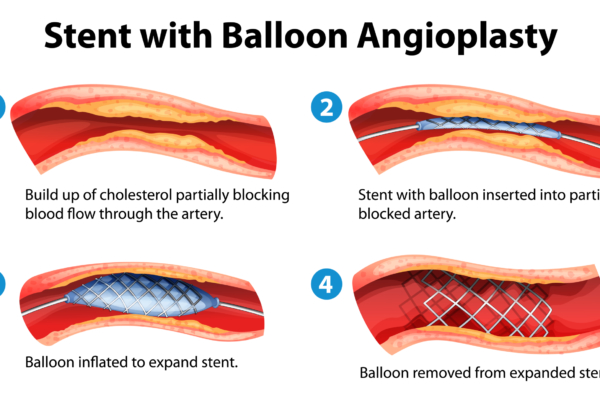 What is a stent. Different types of stents. Stent angioplasty.