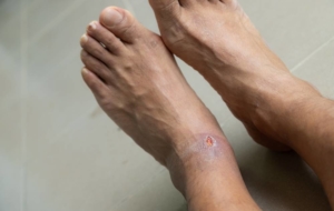 Feet with small open wound on base of ankle