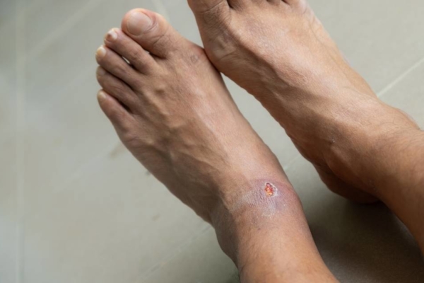 Feet with small open wound on base of ankle