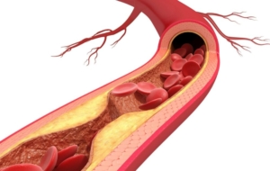 Atherosclerosis