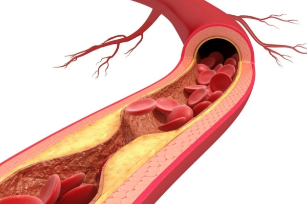 Atherosclerosis