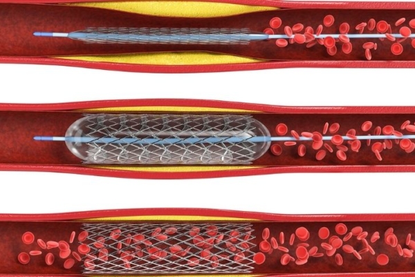 what is angioplasty