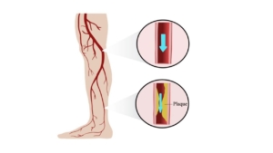 graphic depicting leg arteries being clogged causing peripheral artery disease