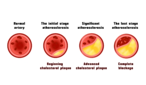 stages of plaque buildup within the arteries