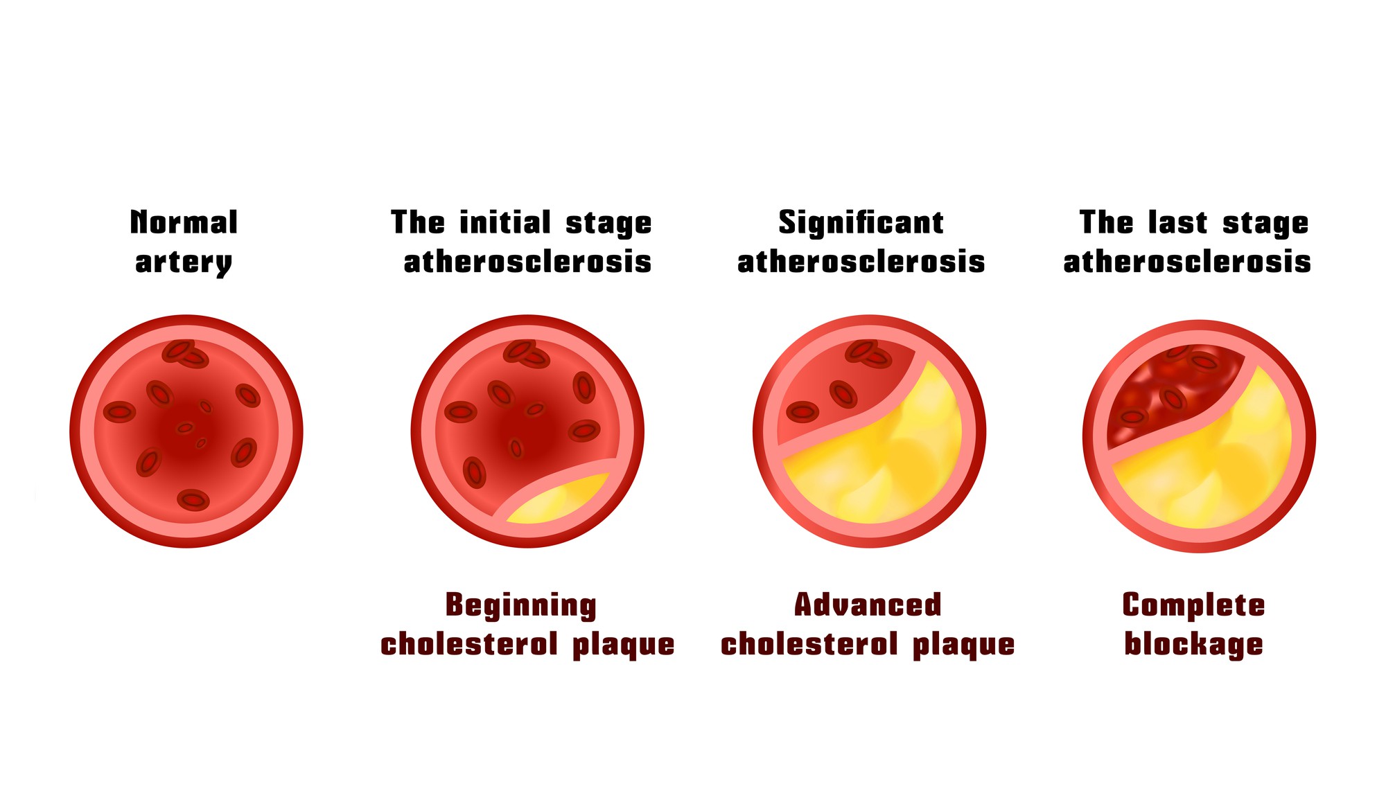 What Causes Artery Plaque Atherosclerosis Symptoms Causes What Causes Artery Plaque Atherosclerosis Symptoms Causes