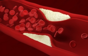 What Is Arterial Plaque?