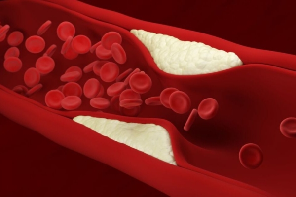 What Is Arterial Plaque?