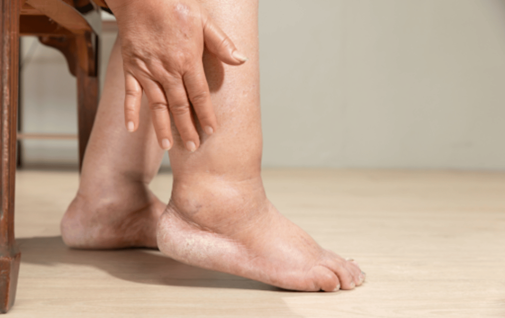 What Happens if PAD Goes Untreated