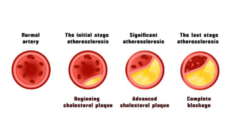 The Differences Between Neuropathy and PAD