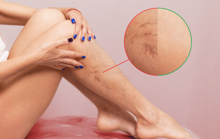 Warning Signs & Symptoms of Blocked Arteries in the Leg