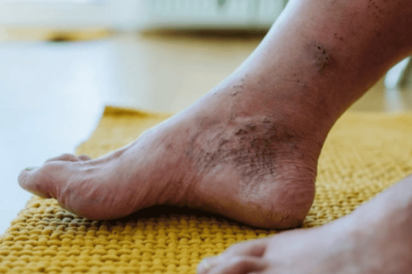 PAD on lower limbs