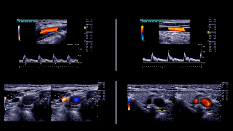 Vascular Ultrasound Images