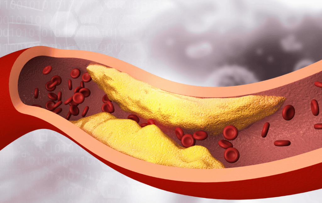 Calcium Deposits and Peripheral Artery Disease (PAD)