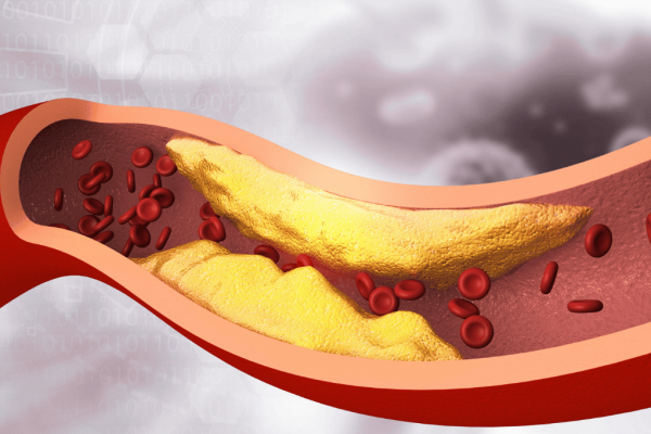 Calcium Deposits and Peripheral Artery Disease (PAD)