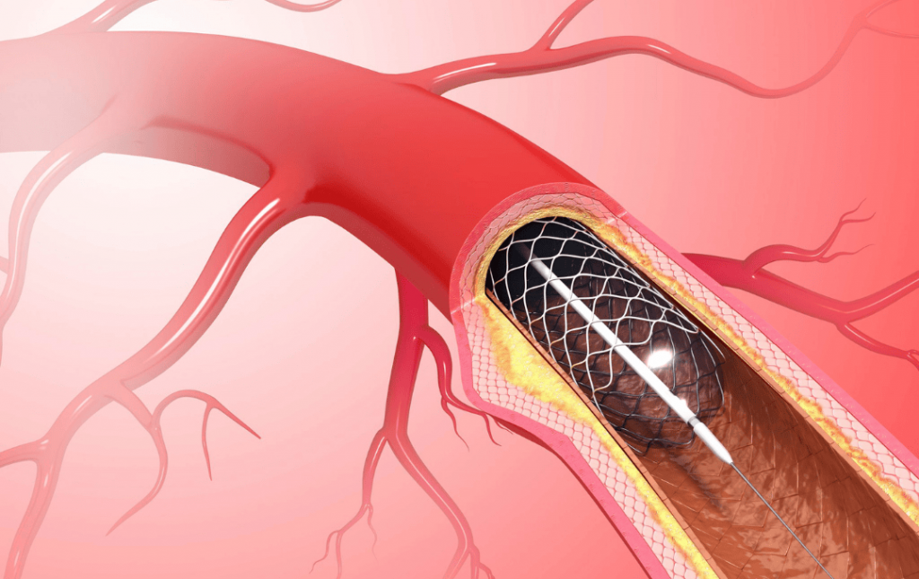 Types of Stents for Peripheral Artery Angioplasty