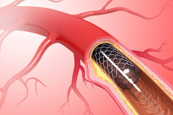 Types of Stents for Peripheral Artery Angioplasty