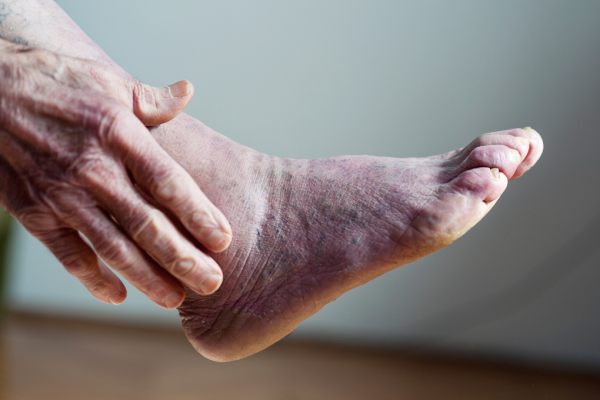 Why Are My Feet Turning Blue?