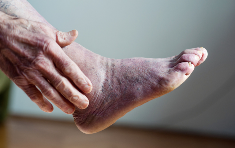 Why Are My Feet Turning Blue?