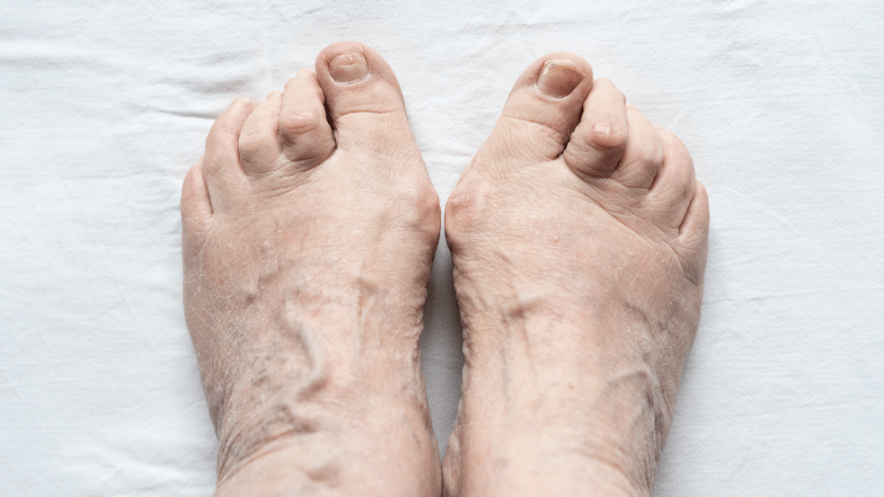 Common Reasons Toenails Stop Growing or Grow Slowly