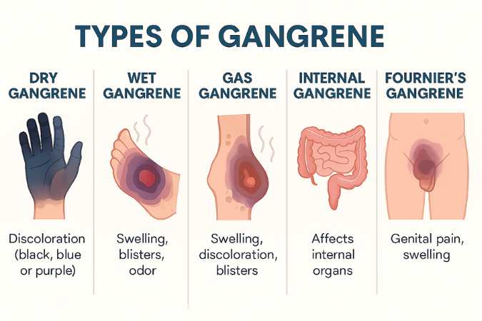 Types of Gangrene
